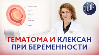 Гематома невынашивание и клексан при беременности Дементьева СН [upl. by Saitam]