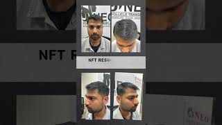 Amazing 4Month Hair Transplant Results  3000 Grafts Transformation  NEO Follicle Hair Transplant [upl. by Aekin]