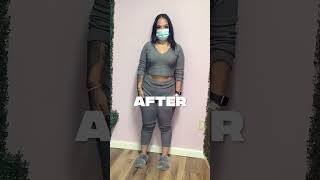 41 Lbs In 6 Month After Her Orbera Gastric Balloon Procedure 🔥❗️ nonsurgicalweightloss [upl. by Lledor]