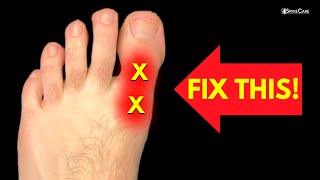 How to Fix BIG TOE Pain for Good [upl. by Ehrsam162]