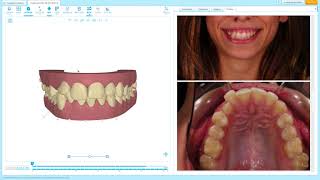 Invisalign Tips Clincheck review Deep Bite and aesthetics [upl. by Kciregor]