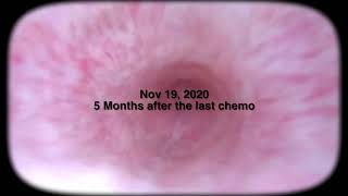 Cystoscopy into the Bladder 6 months after Chemo Nov 2020 [upl. by Ailisec920]