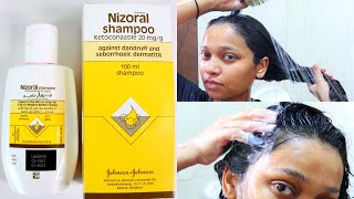 How to use Nizoral shampoo for effective results [upl. by Alonzo747]