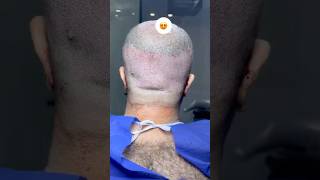 hair transplant donor area recovery hairlosstreatment hairtransplantresultdonorareahairtransplant [upl. by An]