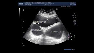 Ultrasound Video showing multiple Diverticula of the urinary bladder [upl. by Attenaj]