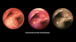 Tracheobronchial Amyloidosis [upl. by Buddy]