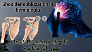 shoulder subluxation in stroke patients shoulder pain after strokeshoulder drop after stroke [upl. by Katuscha]