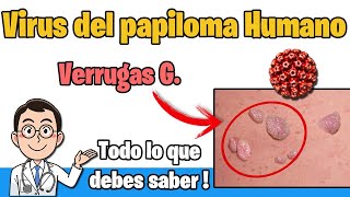 VIRUS del PAPILOMA HUMANO verrugas Sintomas TRATAMIENTO y PREVENCION VPH  HPV [upl. by Nanete]