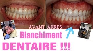 Blanchiment dentaire  AVANTAPRES Revue 25 [upl. by Iredale501]