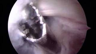 Arthroscopic Removal of Bakers Cyst  ORV  Raymond Whitehead MD [upl. by Giguere]