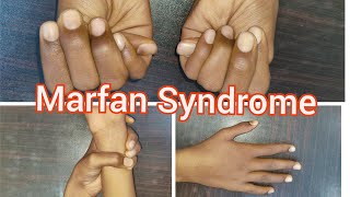 Marfan Syndrome  Clinical Signs [upl. by Yetnruoc]