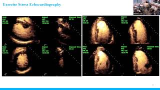 Multimodality Imaging Hypertrophic Cardiomyopathy [upl. by Hannaoj]