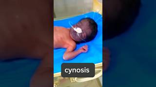 Cynosis baby shortsviral cynosis baby nicu treatment [upl. by Benedicta]