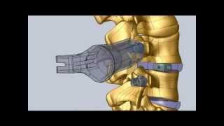 Minimally Invasive Transforaminal Lumbar Interbody Fusion Procedure [upl. by Nogem]