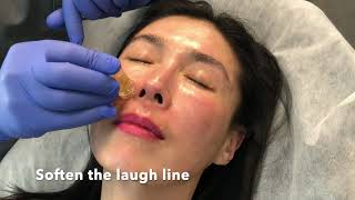 Meso Botox Filler Facial Rejuvenation  Omeed Sani MD  Sani Aesthetics [upl. by Olwen]