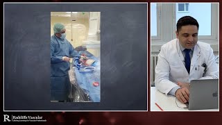 Treating calcified lesions using the Shockwave Lithoplasty® System  Prof K Donas [upl. by Yllut]