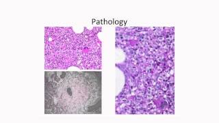 Molecular Profiling of Myelodysplastic Syndromes [upl. by Ayhdiv]