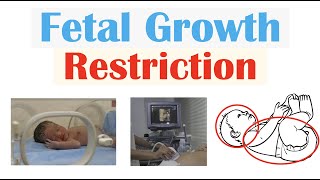 Fetal Growth Restriction FGR IUGR  Types Causes TORCH Infections Diagnosis Treatment [upl. by Stclair]