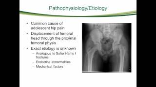 Percutaneous in Situ Fixation of Slipped Capital Femoral Epiphysis vid1 [upl. by Debora245]