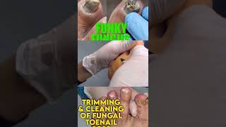 Part 2 Best of Callus Treatments Podiatry  Fungal Nail with Dried Abscess 🦶 Ingrown Nail Treatment [upl. by Gilges]