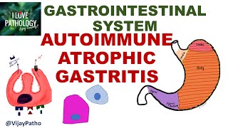 AUTOIMMUNE ATROPHIC GASTRITIS Pathogenesis clinical features morphology amp prognosis [upl. by Otrebile]