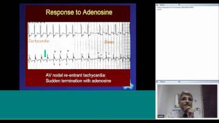 Tachyarrhythmias in Children by Dr Suresh Kumar [upl. by Anne-Corinne]