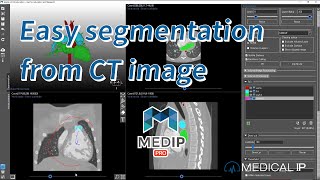 MEDIP PRO  SEGMENTATION [upl. by Dwain466]