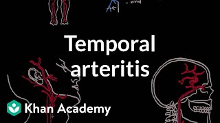 Temporal arteritis  Circulatory System and Disease  NCLEXRN  Khan Academy [upl. by Par]