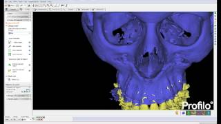 3D analysis of the face jaws airway and dental occlusion [upl. by Urbano603]