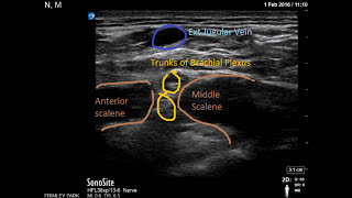 Interscalene catheter [upl. by Giark278]