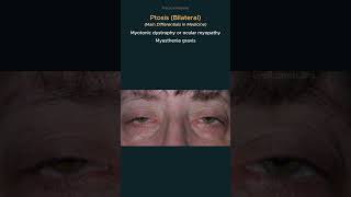 Ptosis Causes of bilateral ptosis osce practicalmedicine diagnosis [upl. by Toshiko696]