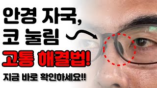 코에 안경자국 생기는 이유 저는 이 방법들로 안경 코받침 자국 이제 안 생깁니다 ㅎㅎ [upl. by Idyh]