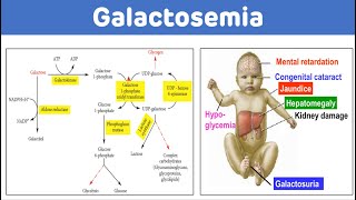 Galactosemia And Galactose Metabolism  Galactosemia Biochemistry [upl. by Zetrom]