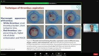 Thrombus aspiration in percutaneous coronary intervention  Tra Giang TRAN MD [upl. by Adarbil938]