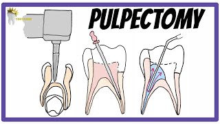 PULPECTOMY  Indications Contraindications Rationale obturation materials [upl. by Anaeg]