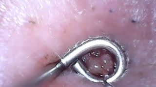 Ingrown vellus hairs amp infected hair follicle  June 9 video [upl. by Inaliel]