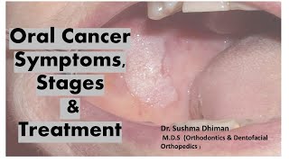 Oral cancer Non healing ulcersoraldisease  Comprehensive Guide to Oral Squamous Cell Carcinoma [upl. by Yearwood]