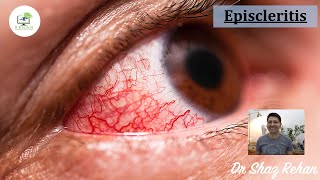 Episcleritis What is it How is it Diagnosed How is it Treated I Dr Shaz Rehan 2021 [upl. by Hasina]