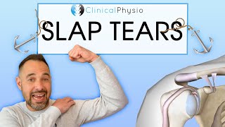 Superior Labral Anterior Posterior Tears  Everything you need to know about SLAP tears [upl. by Wini386]