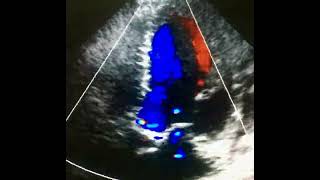 Cardiopatía isquemica fase dilatada e insuficiencia AORTICA [upl. by Murray]