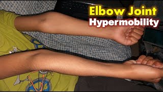 Hypermobile Elbows  Hyperextension of Elbow Joints [upl. by Ratcliffe599]