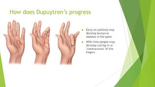 Dupuytrens Contracture Treatment  Everything You Need to Know [upl. by Fife890]