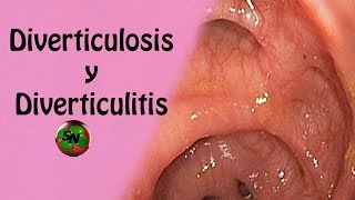 Diverticulosis y Diverticulitis ¿Cómo prevenirlas y Tratamiento natural [upl. by Walkling452]