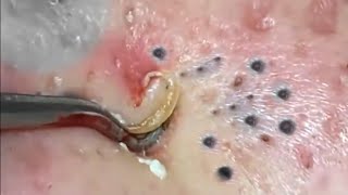 Blackhead Removal Tools Should I use them Pimple Popper Tools [upl. by Akilaz100]