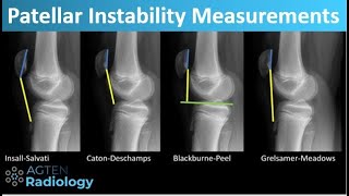 Patellar Instability  What and How to Measure [upl. by Shermy]