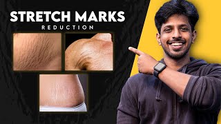 Get Rid of Stretch Marks  Natural Home Remedies amp Treatments [upl. by Abbey]