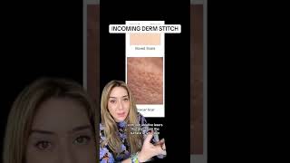 Treating Acne Scars Part 2 shorts [upl. by Florri]