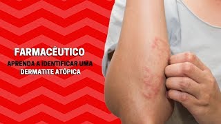 FARMACÊUTICO  Aprenda a identificar uma dermatite atópica [upl. by Orag945]