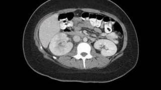 Radiology Rounds  A Radiologist Auntminnie CT scan of pyelonephritis [upl. by Mik]