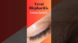 Blepharitis or eyelashes dandruff [upl. by Saidel]